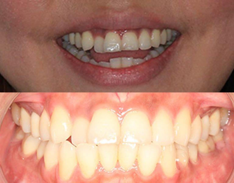 Invisalign in Auckland results 2