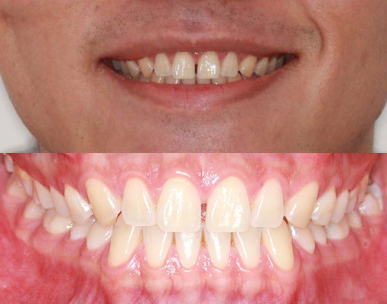Invisalign in Auckland results 7